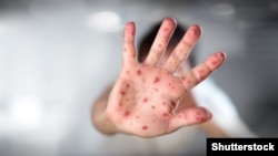 Ospice su jedan od najzaraznijih virusa na svijetu, ali se mogu spriječiti s dvije doze vakcine MMR.